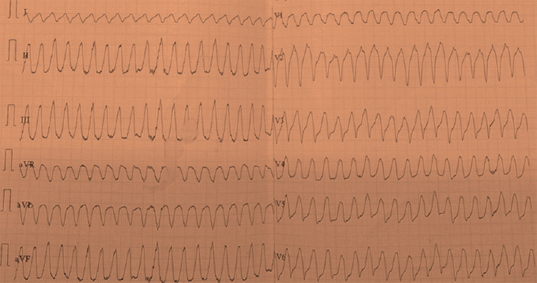 Ventricular flutter evident on lead I.